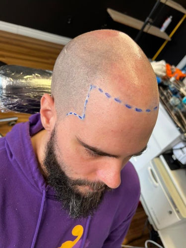 Homme à la peau foncée avec un contour dessiné indiquant la zone de traitement.