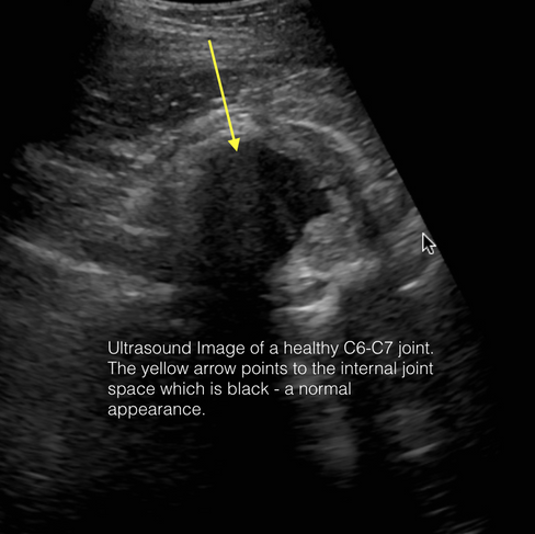 an ultrasound image of a healthy C6-C7 joint in a horse's neck.