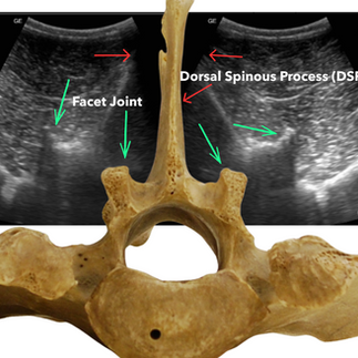 showing comparison of what the an equine veterbrae looks like like vs what it looks like on ultrasound