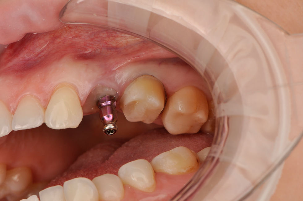 Снятие слепков под керамические коронки