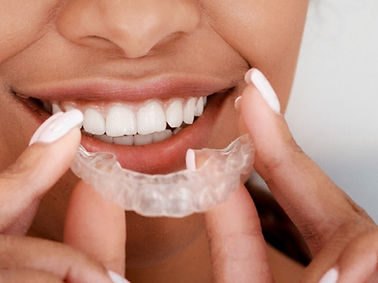 Invisalign Consultation_edited.jpg