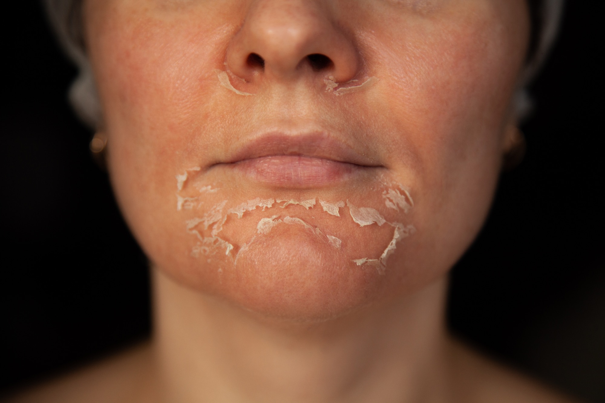 Close-up of skin lightly flaking as it renews in the days after a peel