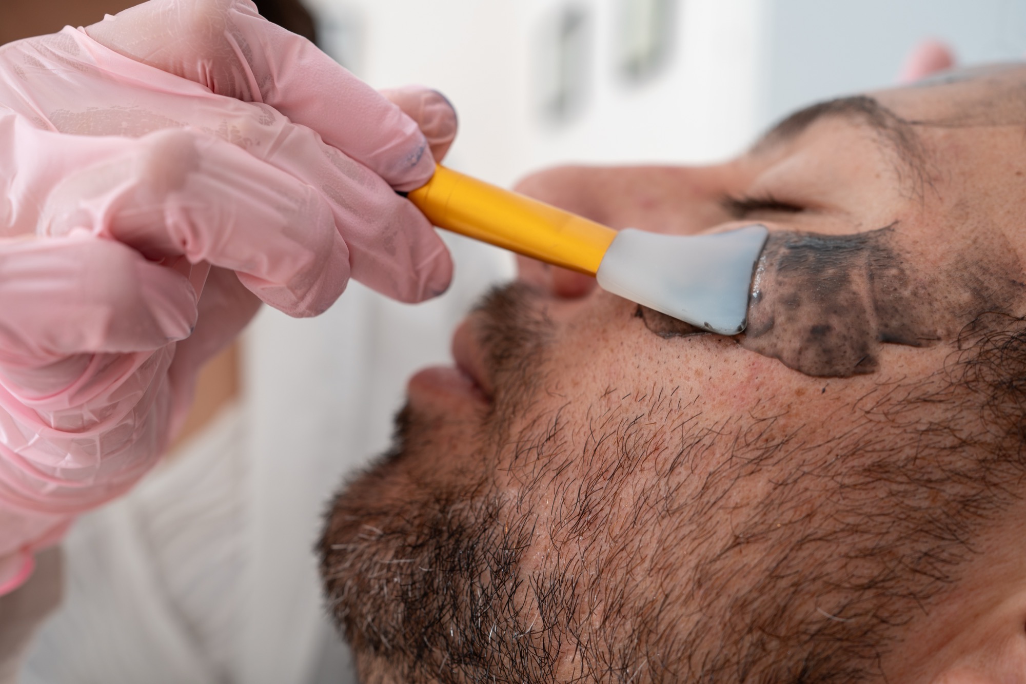 Close-up of a dark activated-charcoal layer being applied to the skin with a brush before the laser pass