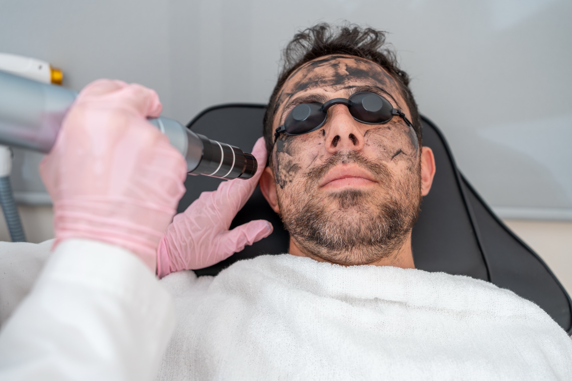 A man receiving a carbon laser peel — a layer of activated charcoal on the face, protective eyewear, and a laser handpiece