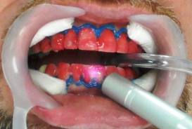 Scopri il trattamento di pulizia e sbiancamento dentale con laser presso Union Dental Clinic: una soluzione efficace e sicura per un sorriso luminoso e sano. Approfitta della tecnologia all'avanguardia per risultati rapidi e duraturi!