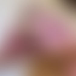 Calvície precoce: por que jovens estão perdendo cabelo?