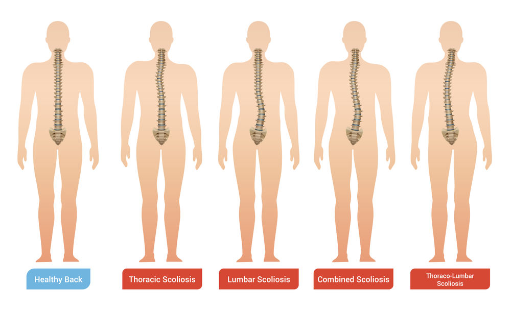 The Ins and Outs of Scoliosis