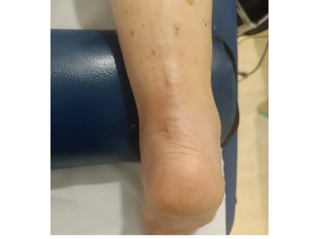 Tratamiento en rotura de tendón de Aquiles en Centro de fisioterapia Clara Miranda