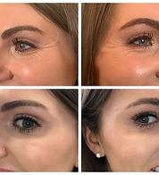 before and after botox2.jpg