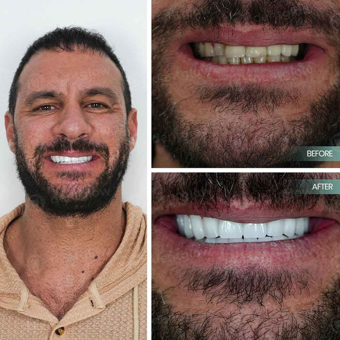 dental implants turkey reviews izmir turkey