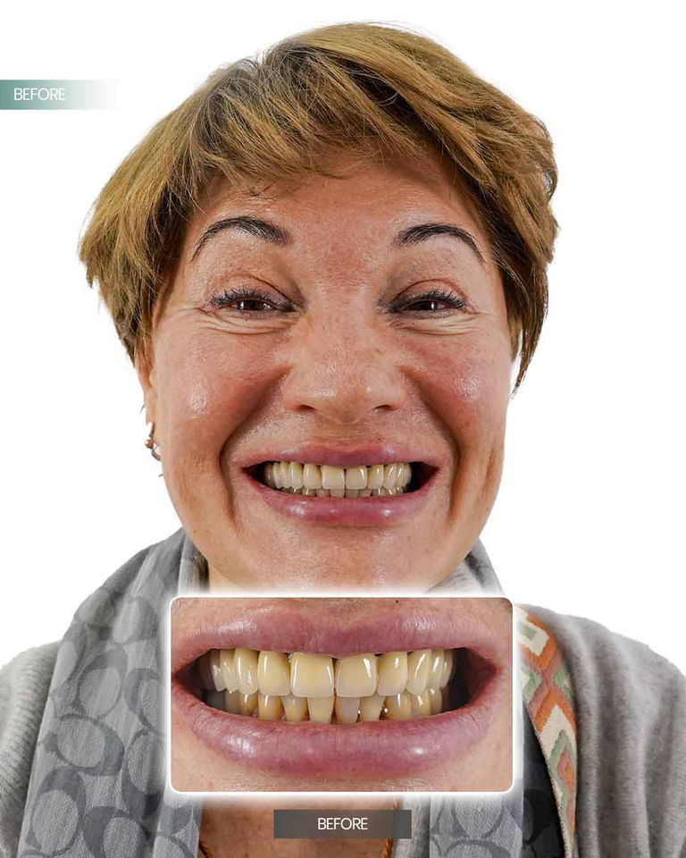 dental implants turkey reviews izmir turkey
