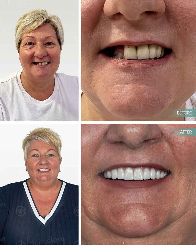 all on 6 dental implants before and after izmir turkey