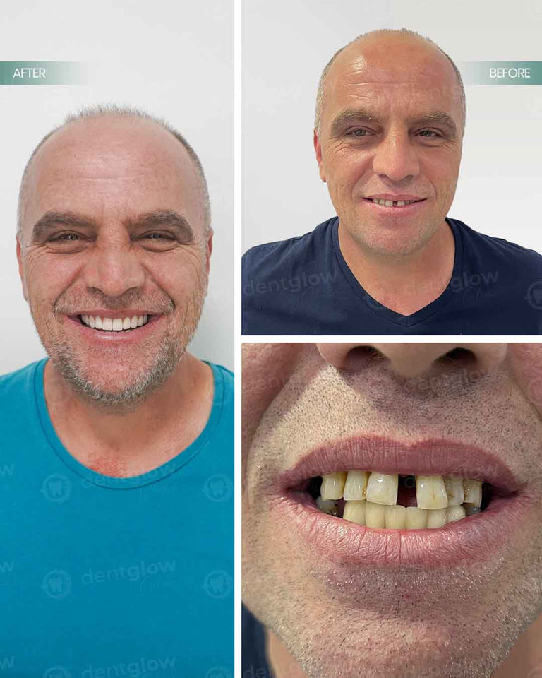 dental implants turkey reviews izmir turkey
