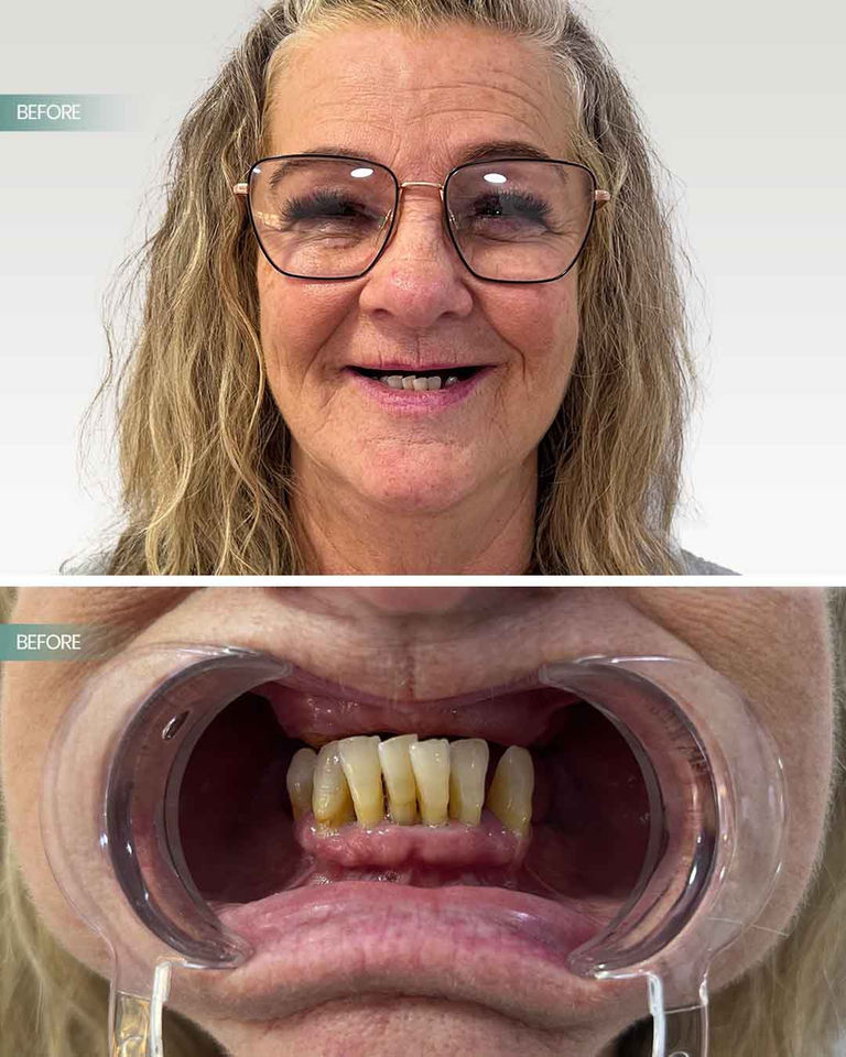 all on 6 dental implants before and after izmir turkey