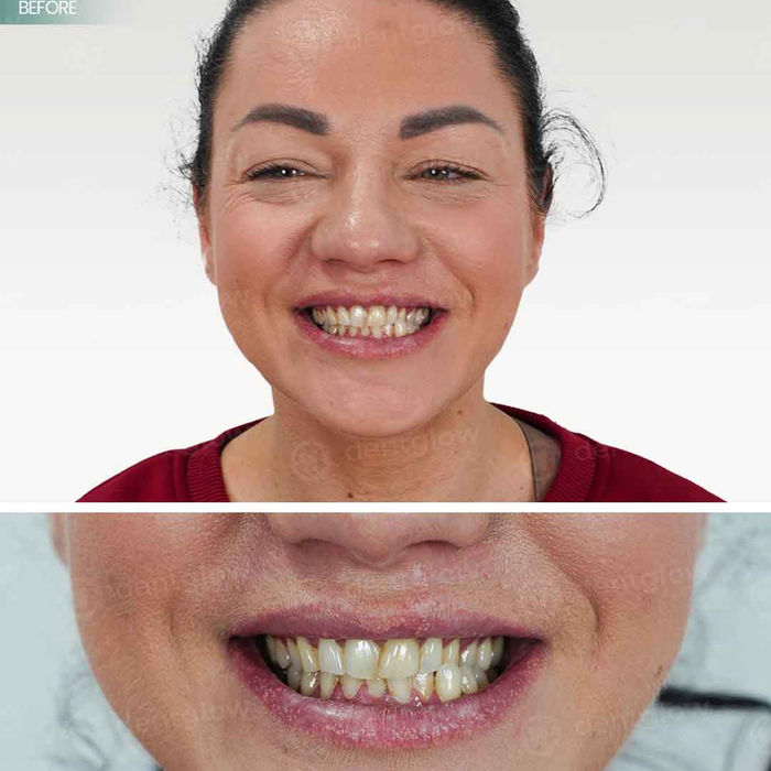 dental implants turkey reviews izmir turkey