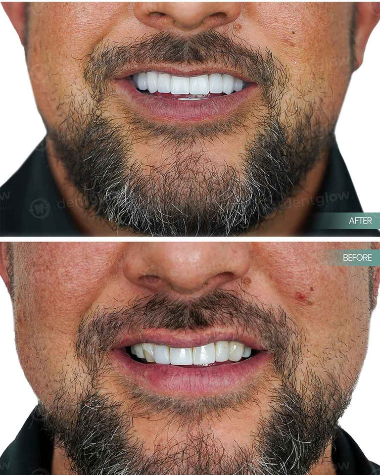 dental implants turkey reviews izmir turkey