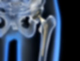 defective hip.jpeg