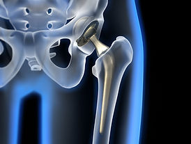 defective hip.jpeg