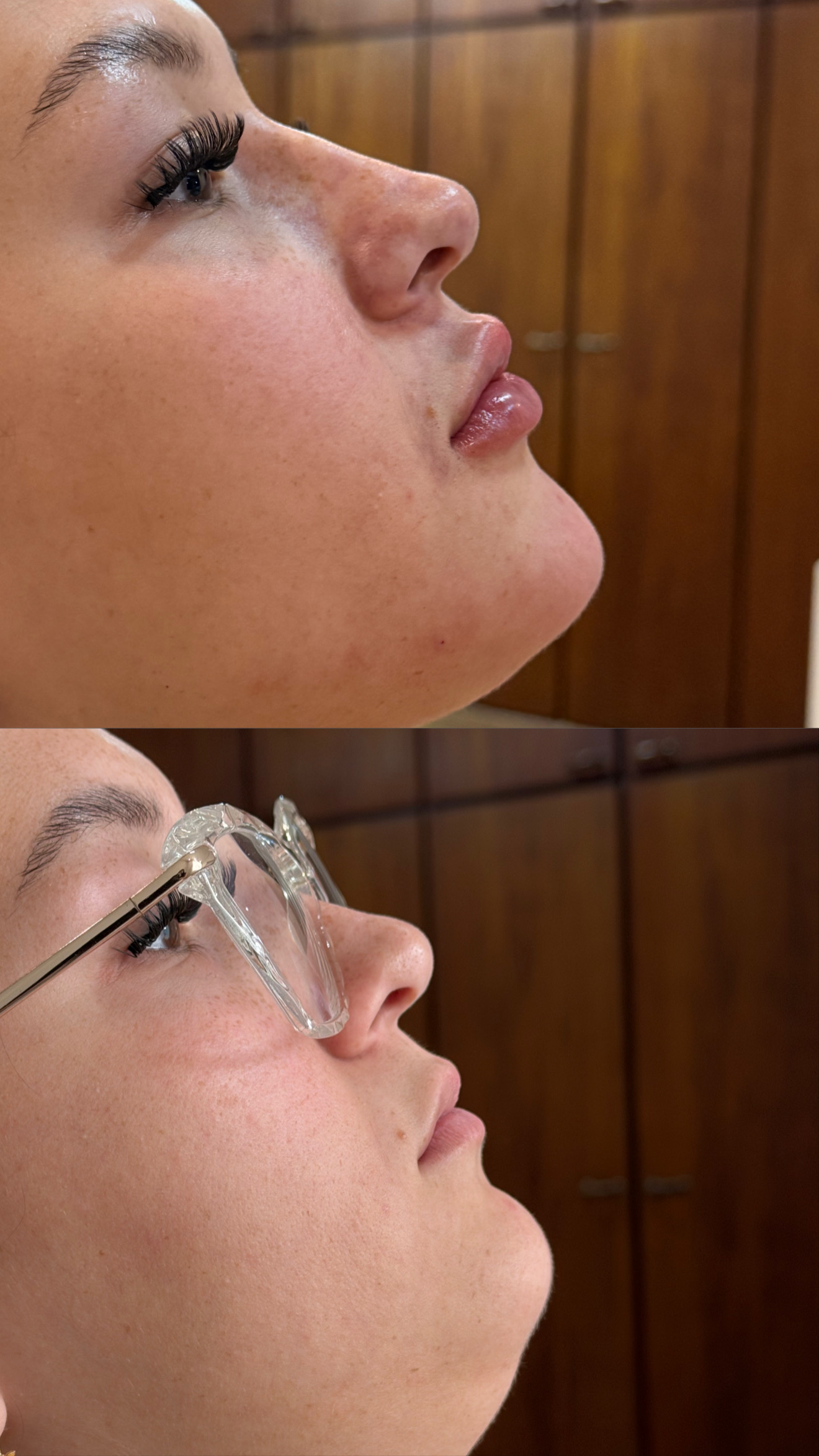 Resultado de procedimento estético, harmonização facial — antes e depois