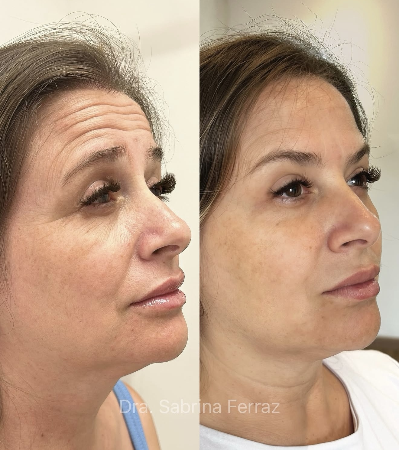 Resultado de procedimento estético, perfil facial — antes e depois