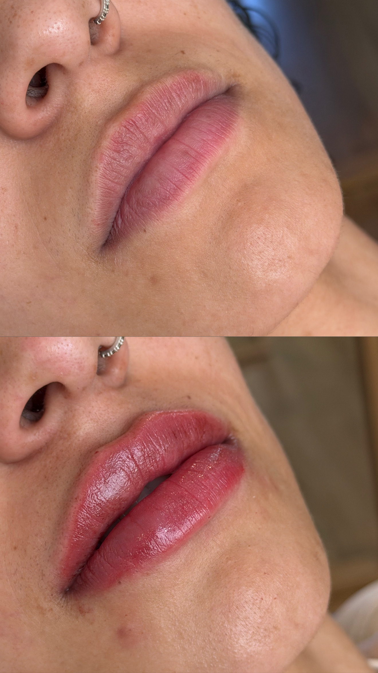 Resultado de procedimento estético, preenchimento labial — resultado