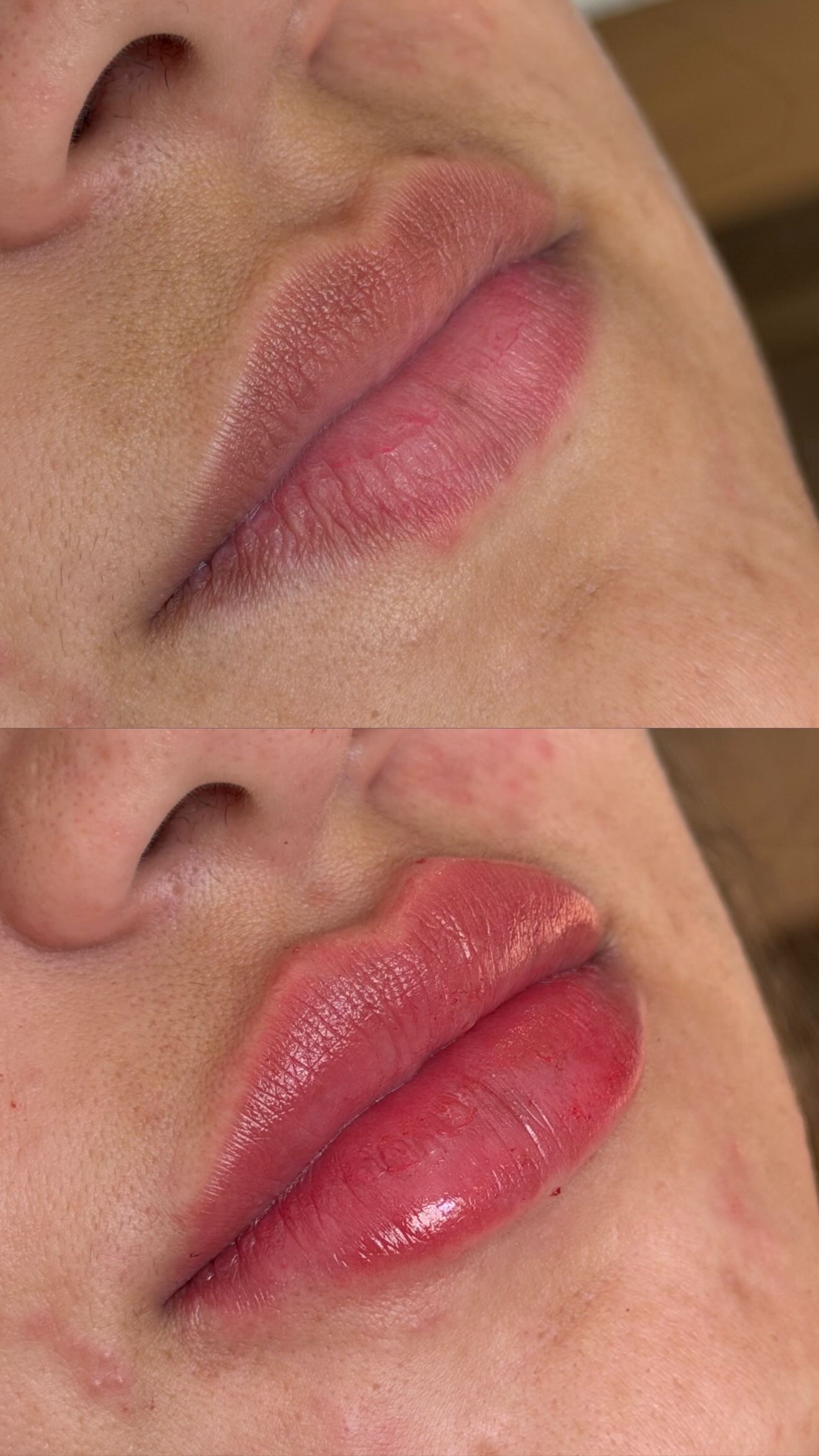 Resultado de procedimento estético, preenchimento labial — antes e depois
