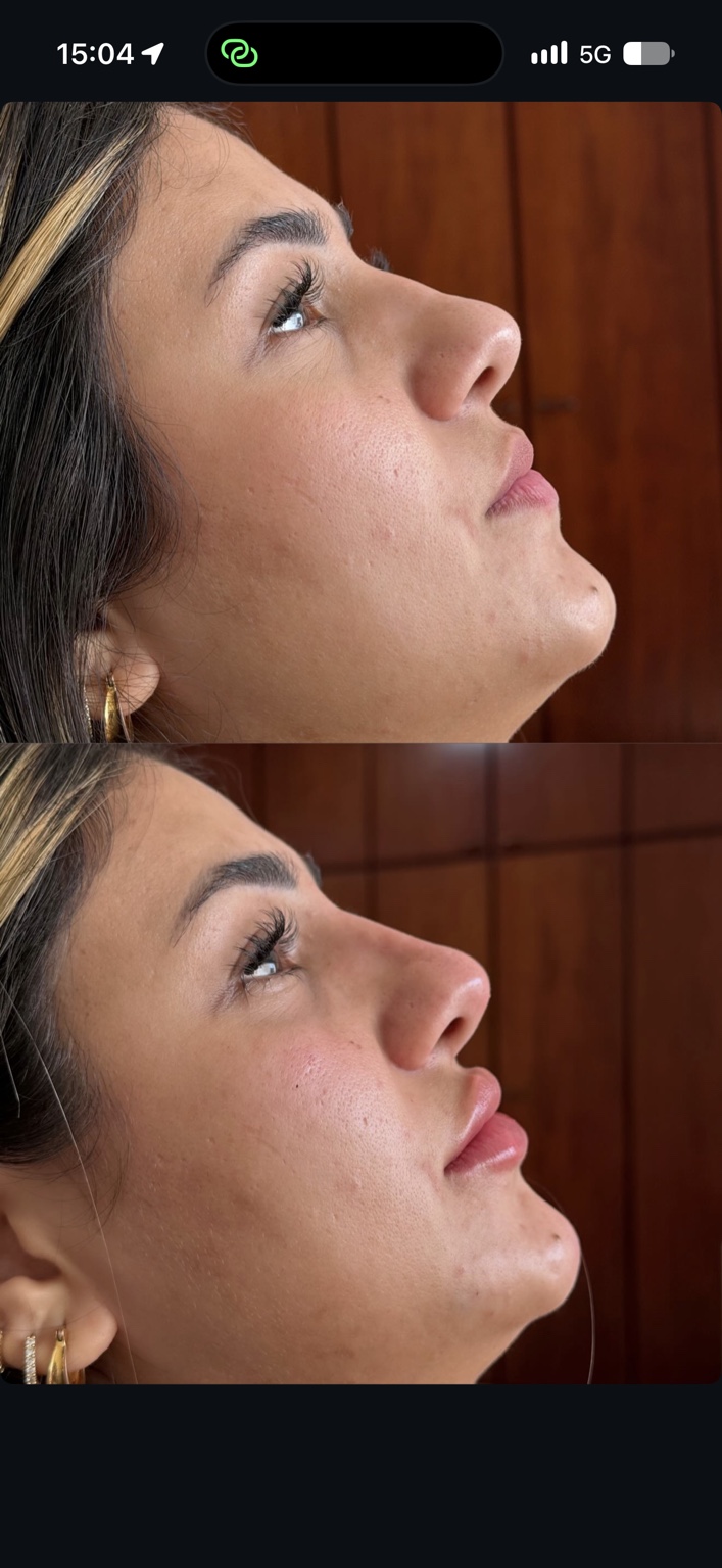 Resultado de procedimento estético, harmonização facial — perfil