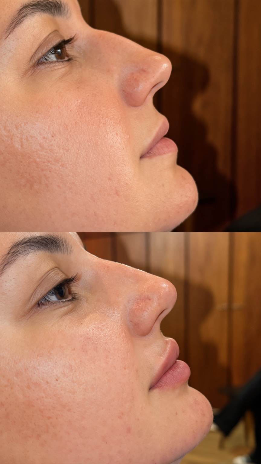 Resultado de procedimento estético, harmonização facial — perfil