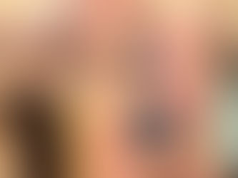 تأثير الحجامه العلاجية و التدليك بالاحجار علي الم الفقرات القطنية المصاحب للإنزلاق الغضروفي القطني