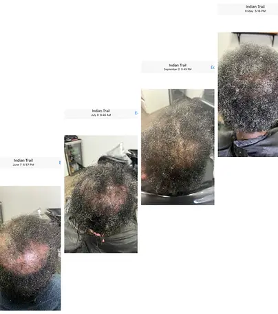 hair restoration,thinning hair, hair loss,