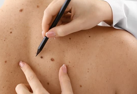 skinremoval