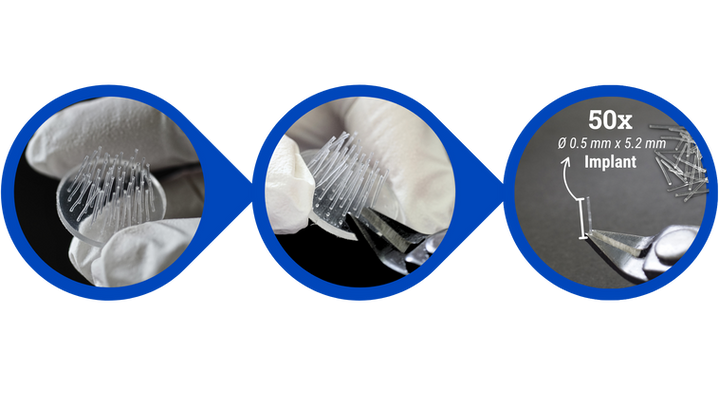 Implant Batch Size Multi Free-D.png