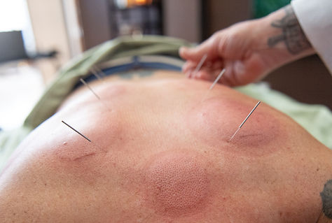 Acupuncture at Zensational in Faribault, MN