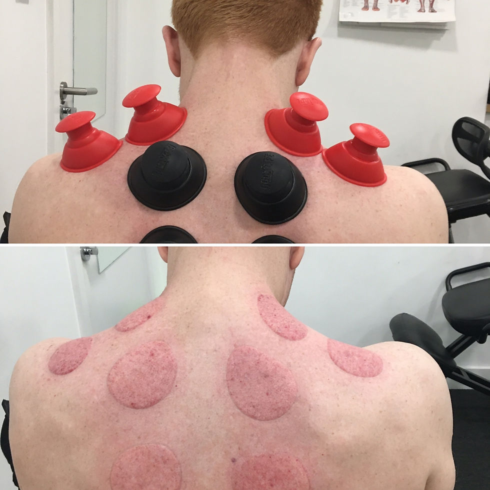 Two-panel image: Top shows a person with red and black cupping therapy cups on their back; bottom shows circular marks. Clinic setting.