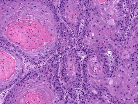 Most Squamous Cell Carcinoma Recurrences Occur Within 3 Years of Diagnosis 