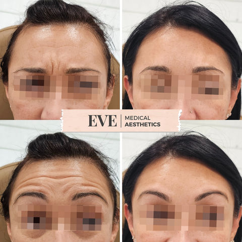 Glabellar & Forehead Treatment