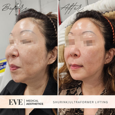 Jowl & Neck Lift with SHURINK/ULTRAFORMER
