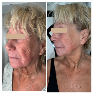 Les résultats observés chez Denise : une peau visiblement plus lisse, un teint plus éclatant et une apparence rajeunie.