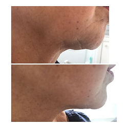 PROMOTION HIFU visage