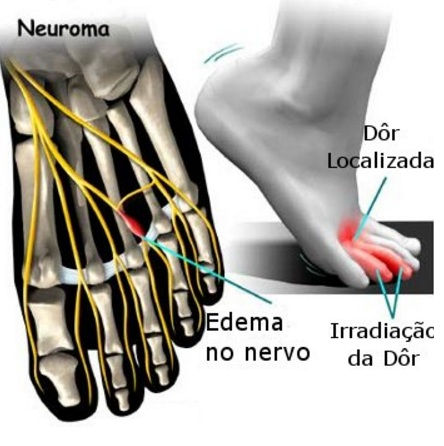Salto alto e neuroma de MORTON