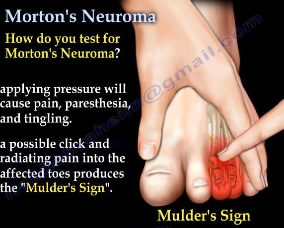 Sinal de MULDER para diagnóstico de neuroma de MORTON