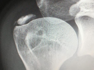 Tendinite calcária - Tratamento sem cirurgia