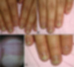 Image showing nail changes due to chemotherapy treatment