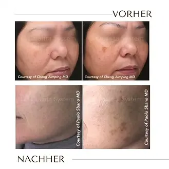 pigmntflecken entfernen(2).webp