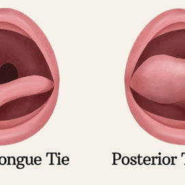 Tongue and Lip Ties: Looking Beyond the Mouth