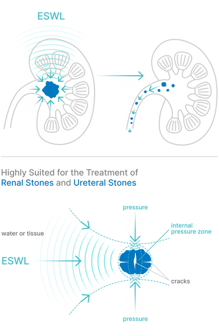Shock waves induce extreme pressure gradients:  Compression and tensile phases. 
