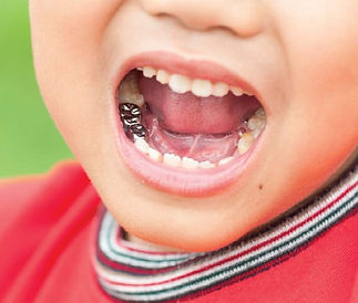 Stainless Steel Crowns for Kids.jpg