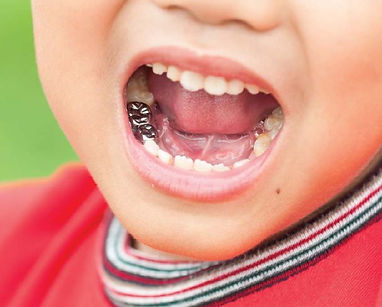 Stainless Steel Crowns for Kids.jpg