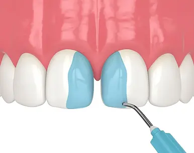 dental-bonding-for-gaps-toms-river-nj.webp