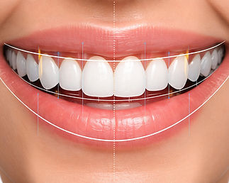 Digital smile design analysis close-up_edited.jpg